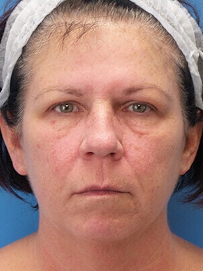 Facelift Before & After Gallery - Patient 409588 - Image 1