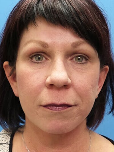 Facelift Before & After Gallery - Patient 409588 - Image 2