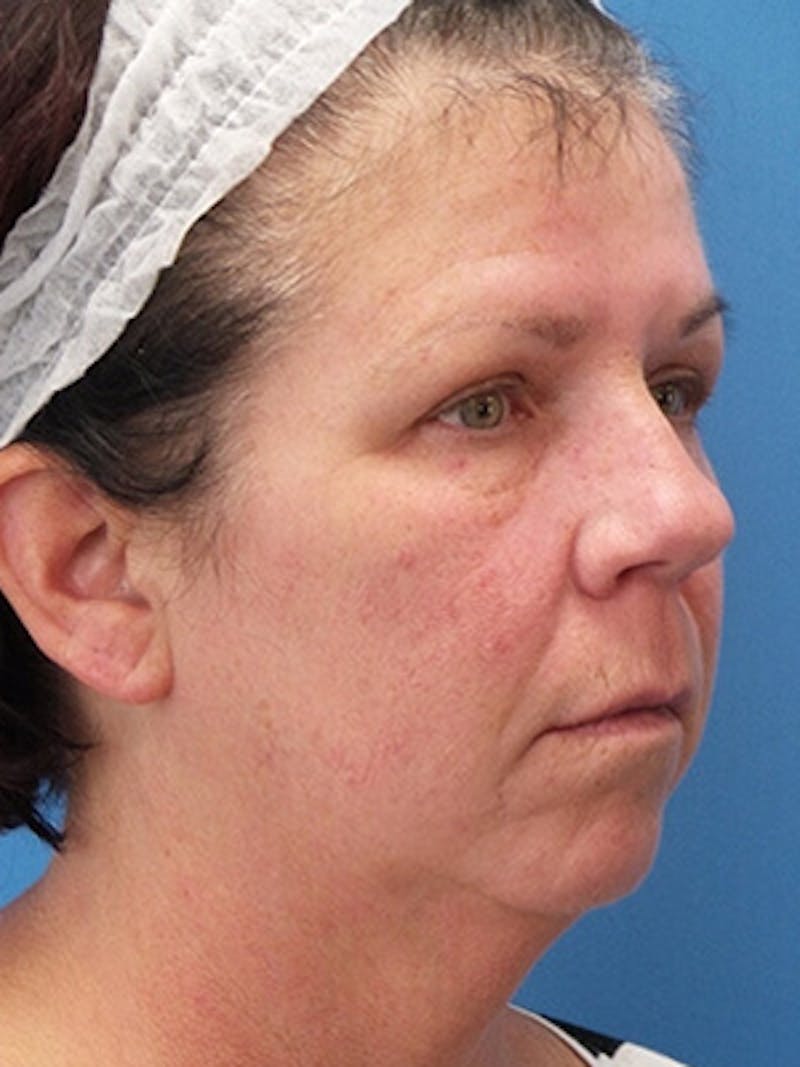 Brow Lift Before & After Gallery - Patient 340920 - Image 3