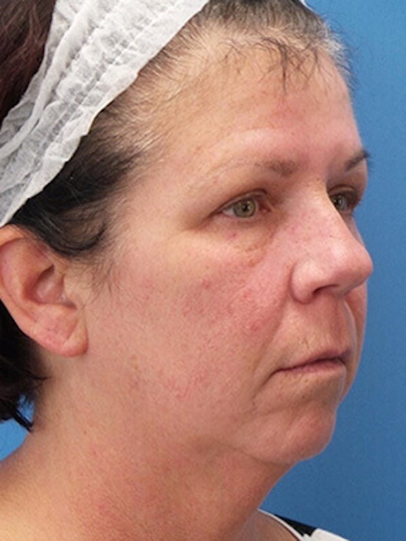 Facelift Before & After Gallery - Patient 409588 - Image 3