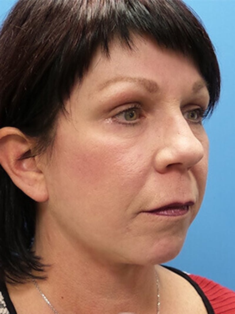 Brow Lift Before & After Gallery - Patient 340920 - Image 4