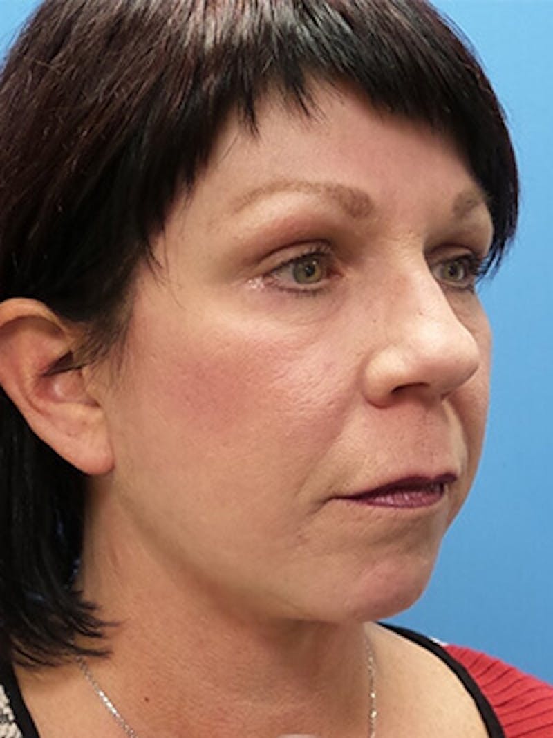 Facelift Before & After Gallery - Patient 409588 - Image 4