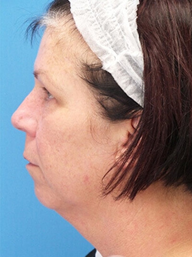 Facelift Before & After Gallery - Patient 409588 - Image 5