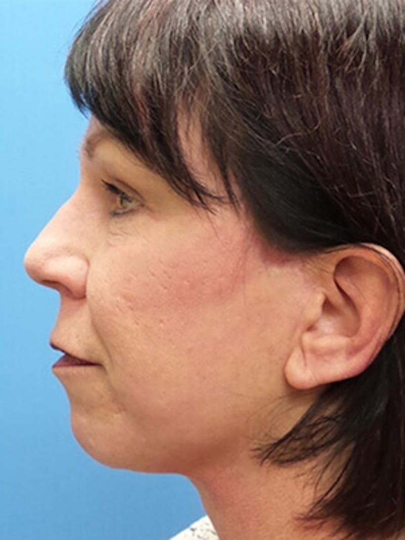 Facelift Before & After Gallery - Patient 409588 - Image 6
