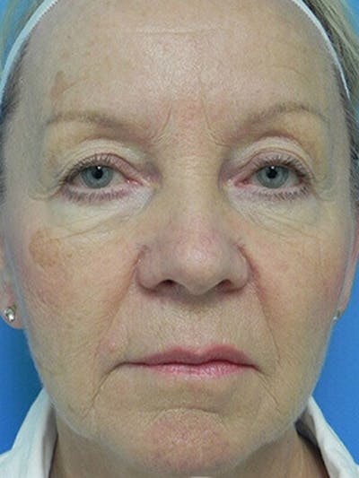 Facelift Before & After Gallery - Patient 101578 - Image 1