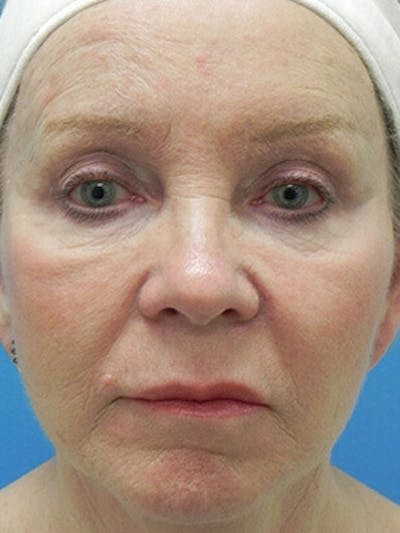 Facelift Before & After Gallery - Patient 101578 - Image 2