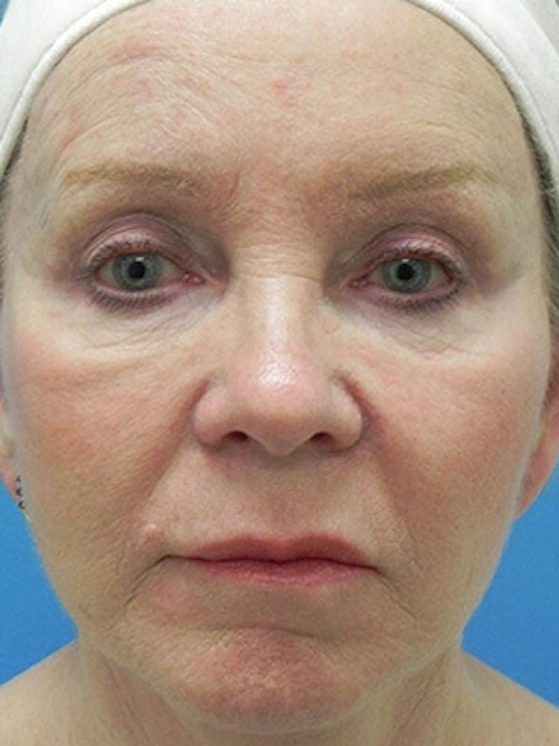 Facelift Before & After Gallery - Patient 101578 - Image 2