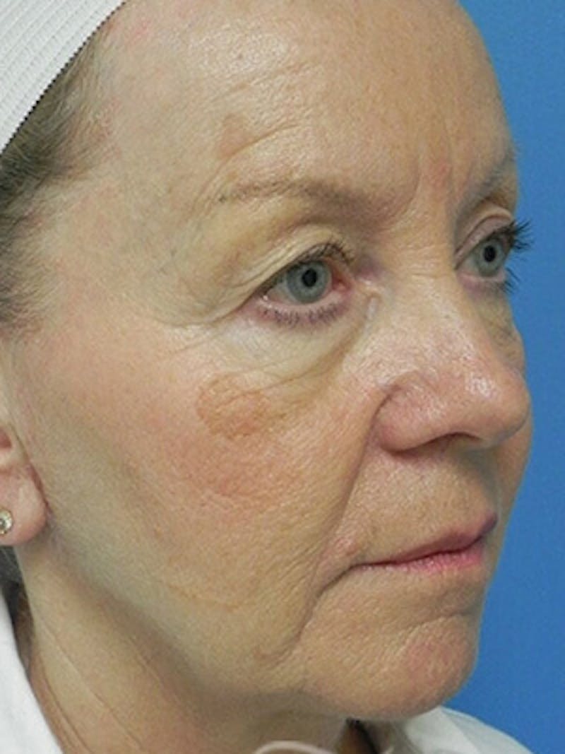 Facelift Before & After Gallery - Patient 101578 - Image 3