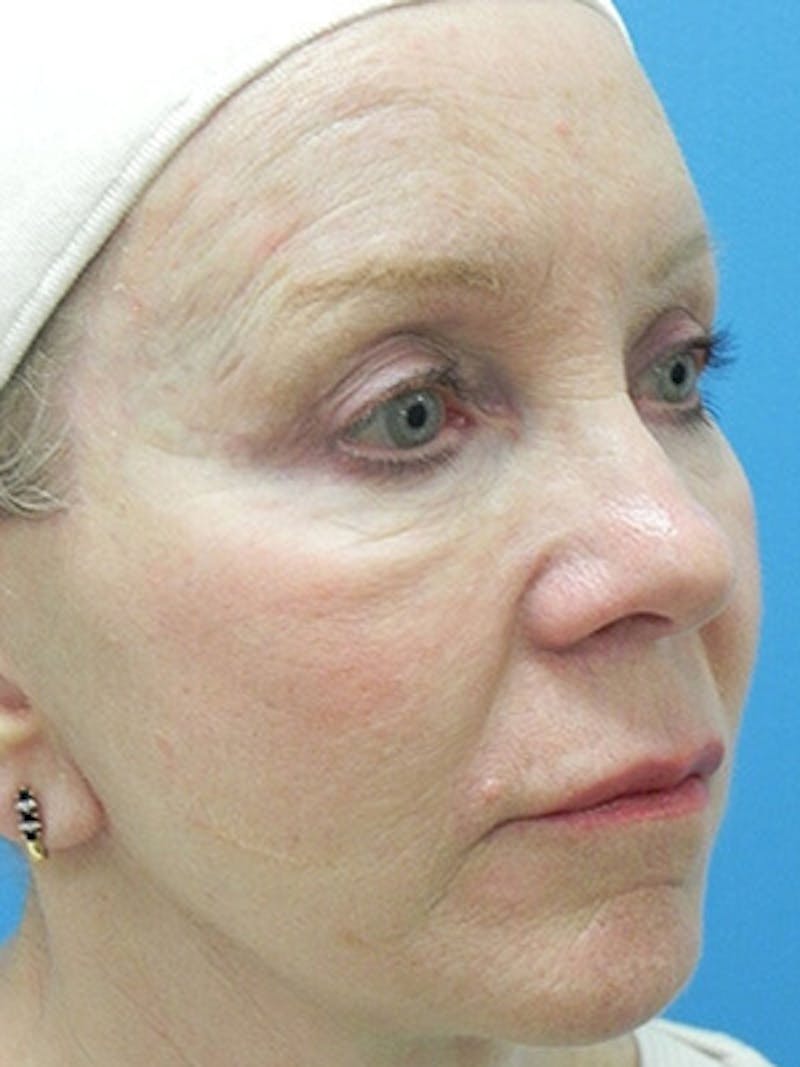 Facelift Before & After Gallery - Patient 101578 - Image 4