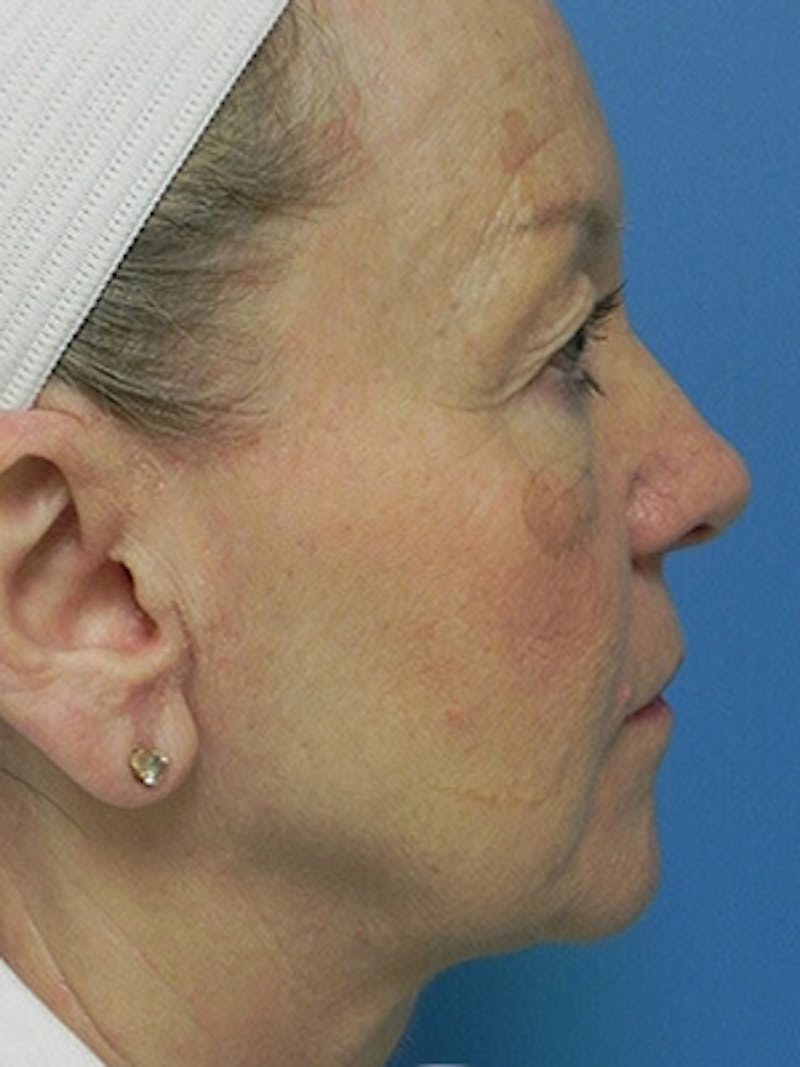 Facelift Before & After Gallery - Patient 101578 - Image 5