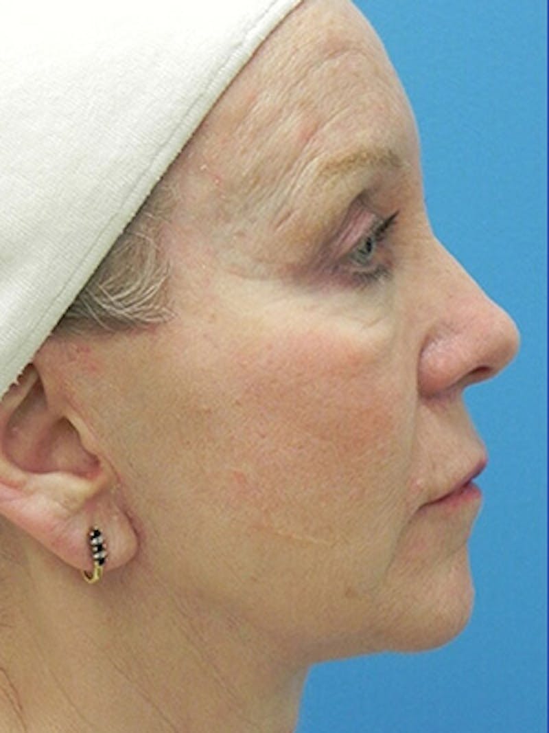 Facelift Before & After Gallery - Patient 101578 - Image 6