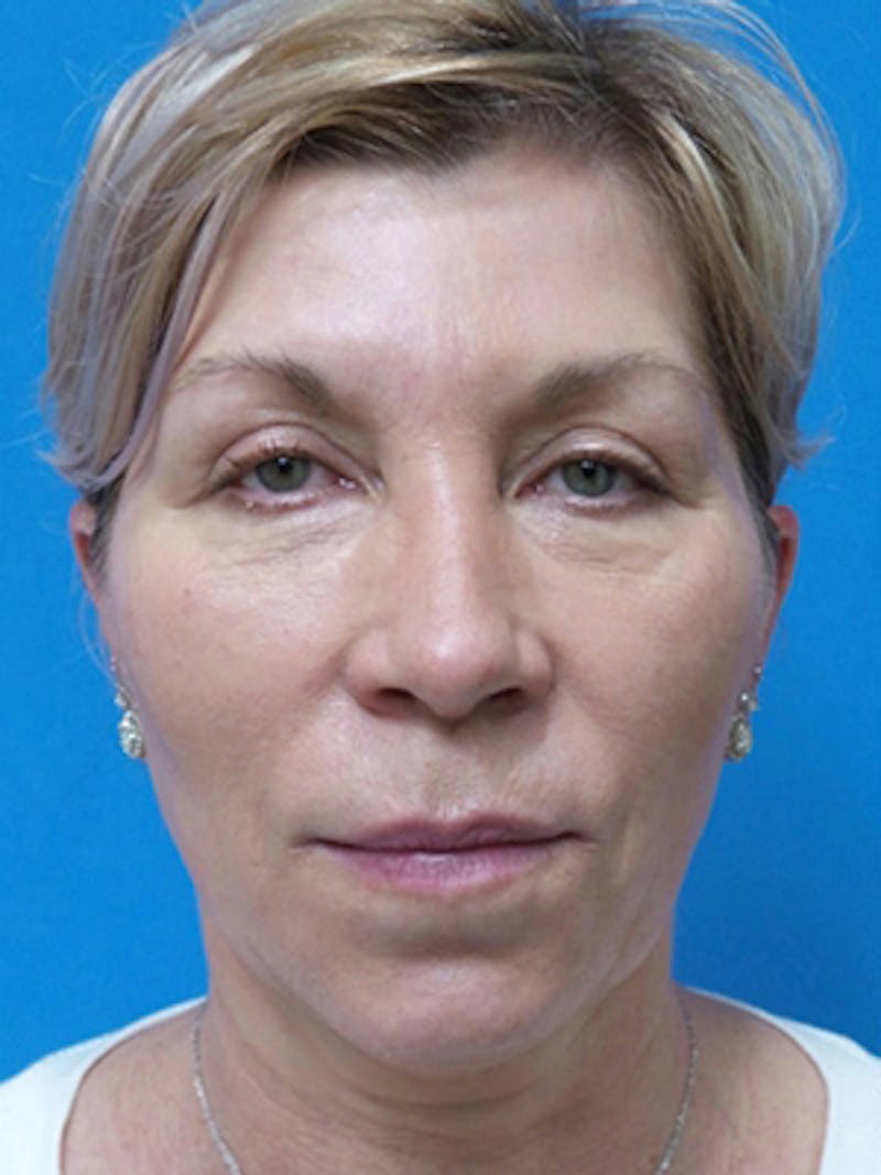 Neck Lift Before & After Gallery - Patient 392045 - Image 3