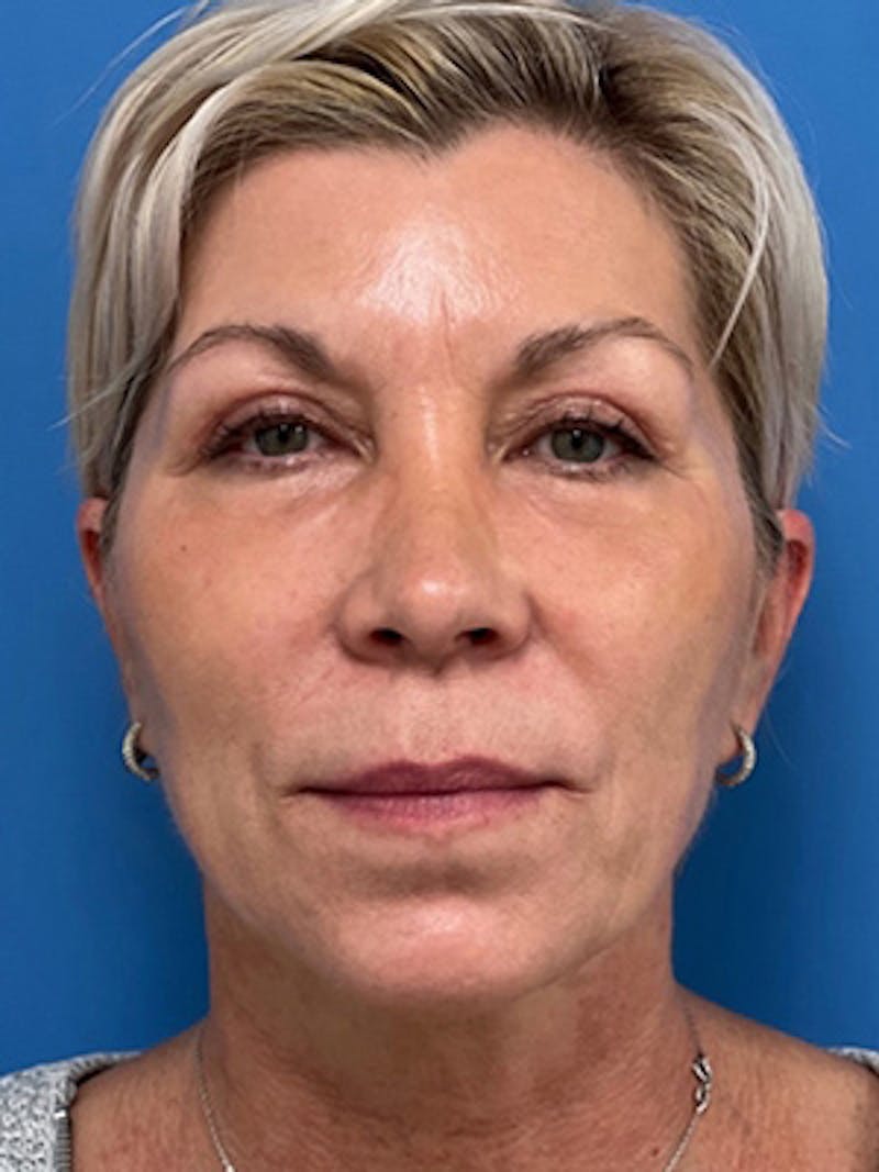 Neck Lift Before & After Gallery - Patient 392045 - Image 4