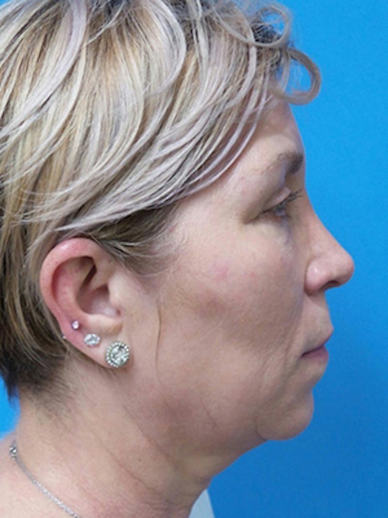Neck Lift Before & After Gallery - Patient 392045 - Image 5