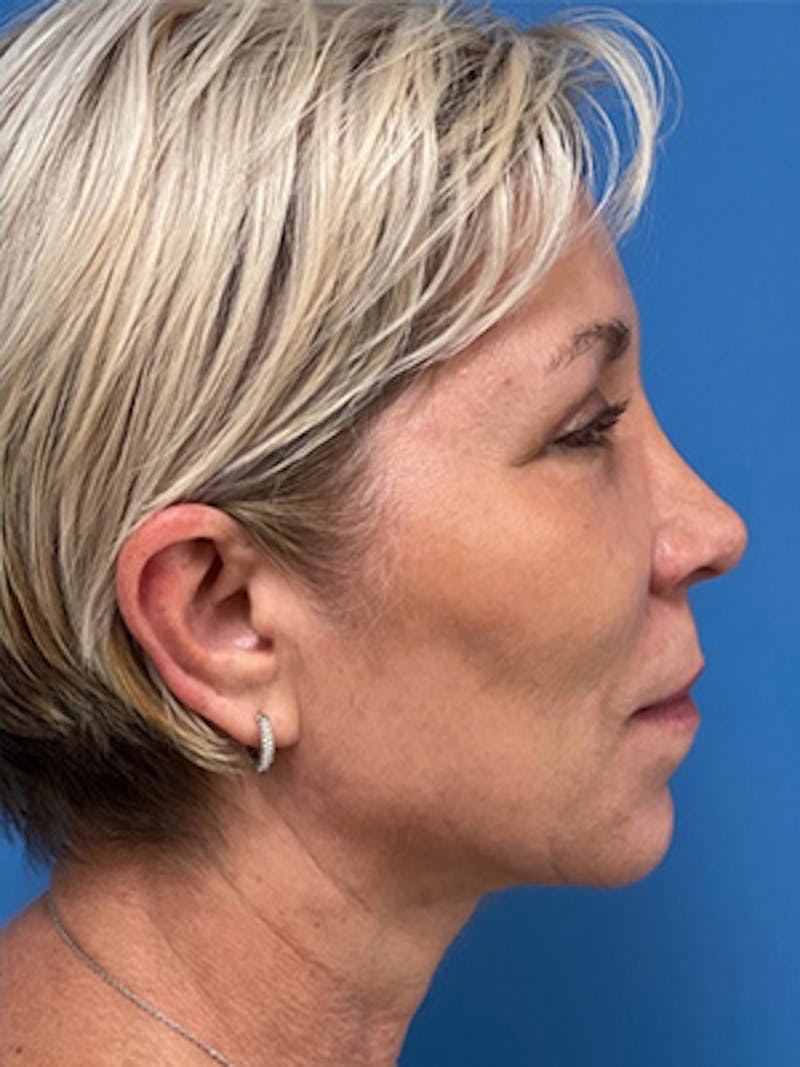Neck Lift Before & After Gallery - Patient 392045 - Image 6