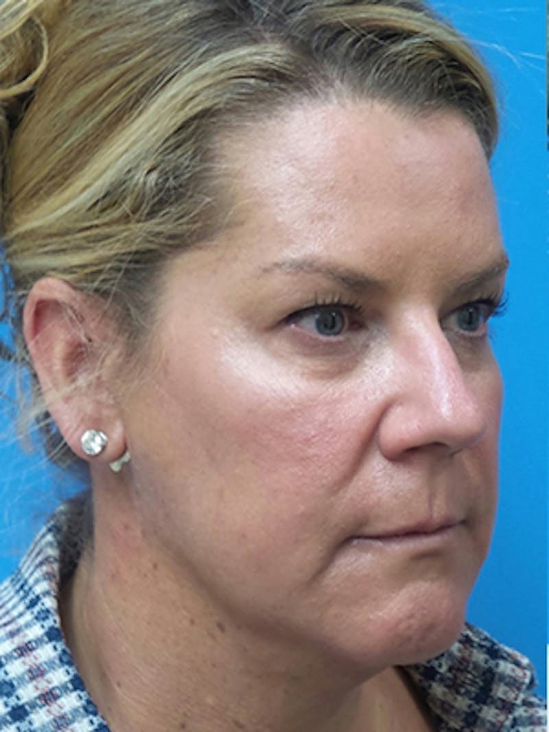 Neck Lift Before & After Gallery - Patient 269000 - Image 5