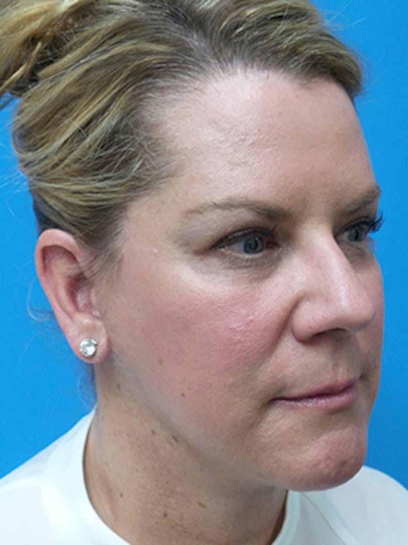 Neck Lift Before & After Gallery - Patient 269000 - Image 6