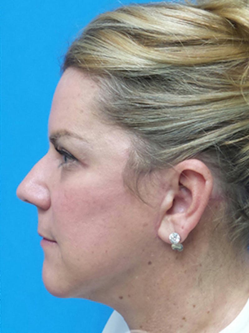 Neck Lift Before & After Gallery - Patient 269000 - Image 2