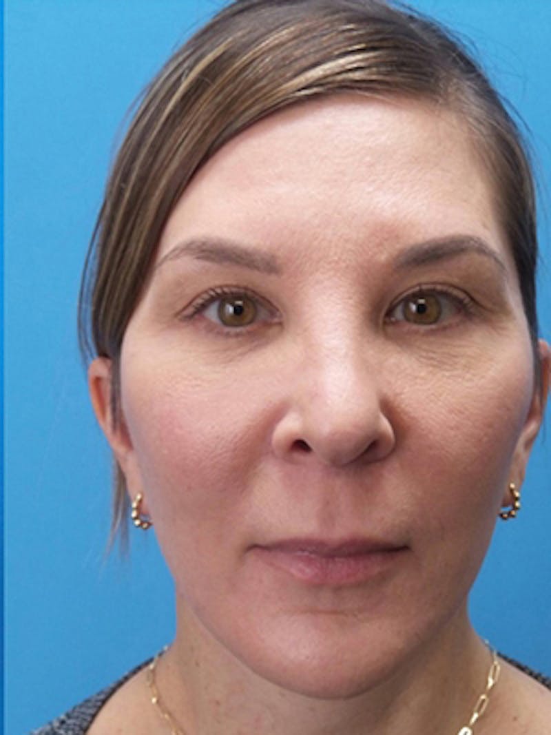 Neck Lift Before & After Gallery - Patient 176536 - Image 4