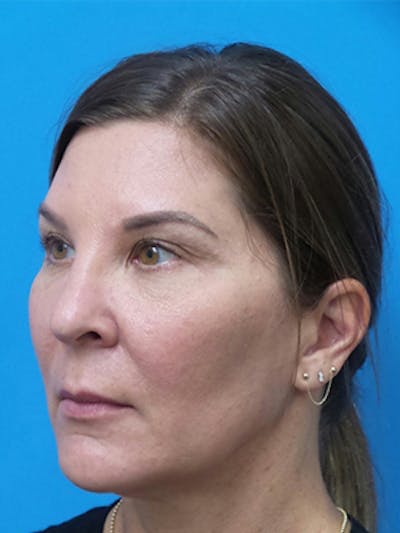 Neck Lift Before & After Gallery - Patient 176536 - Image 1