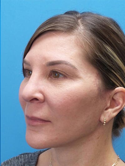 Neck Lift Before & After Gallery - Patient 176536 - Image 2