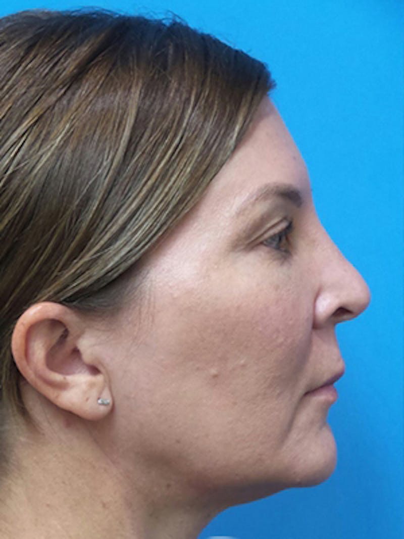 Neck Lift Before & After Gallery - Patient 176536 - Image 5