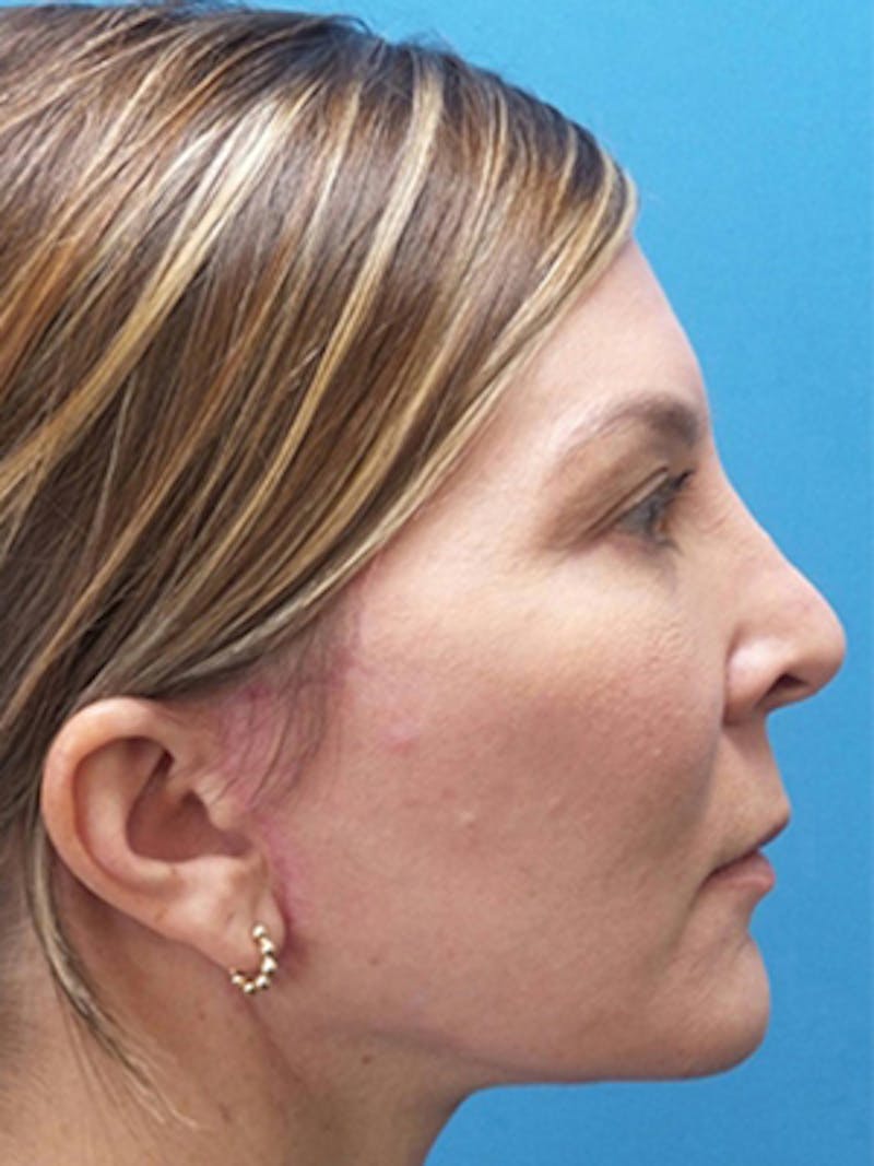 Neck Lift Before & After Gallery - Patient 176536 - Image 6