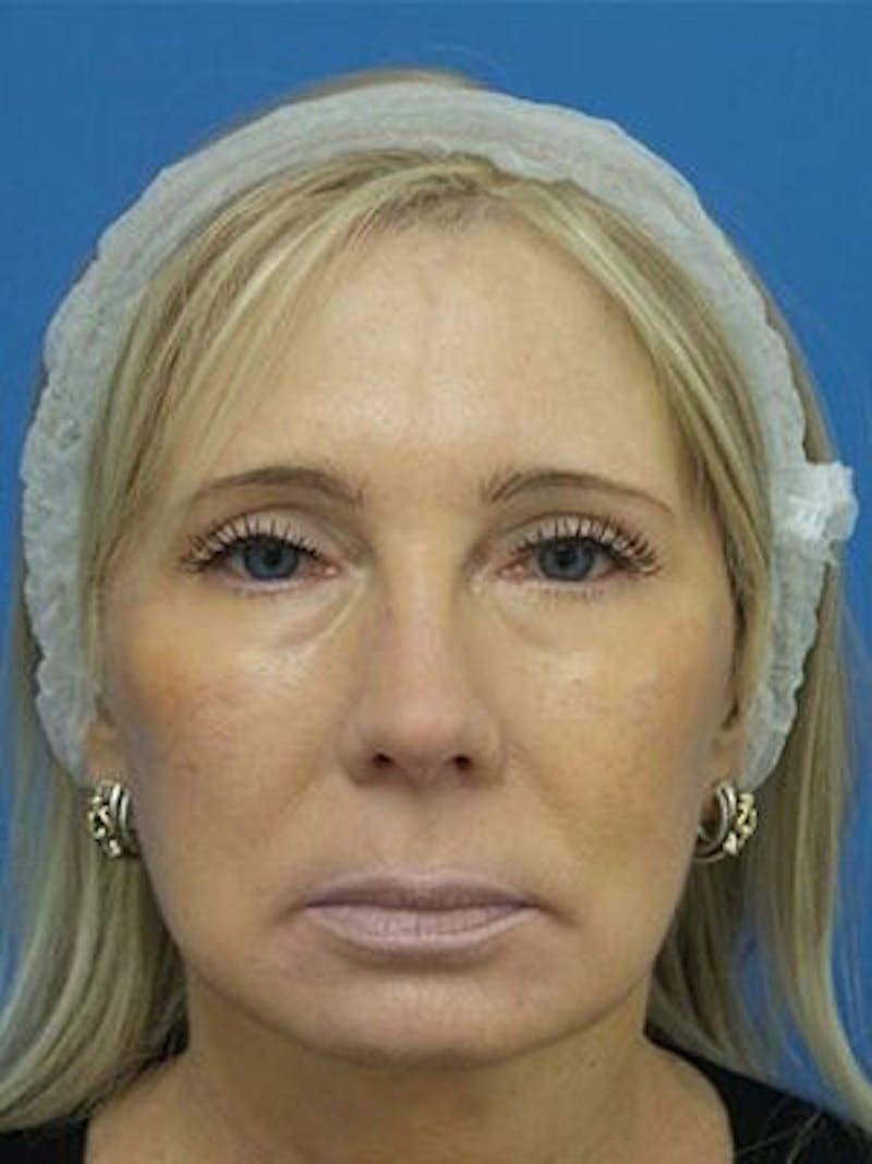Neck Lift Before & After Gallery - Patient 343803 - Image 4