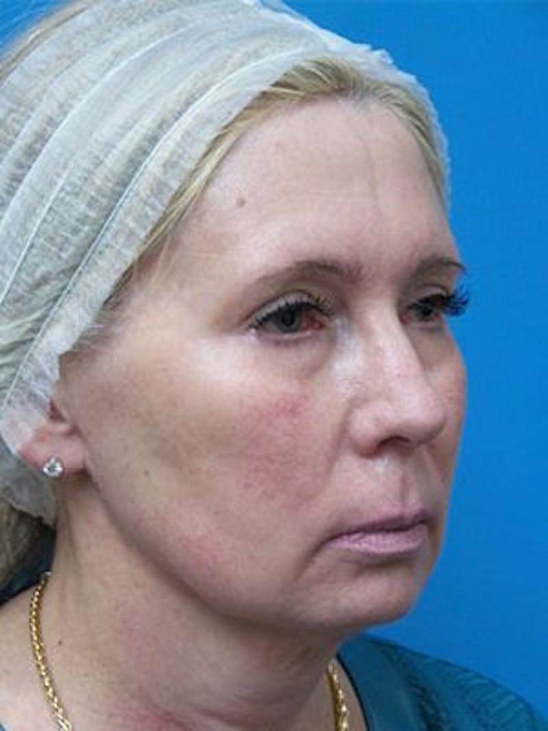Neck Lift Before & After Gallery - Patient 343803 - Image 5
