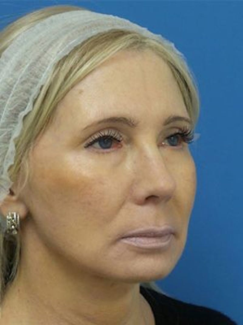 Neck Lift Before & After Gallery - Patient 343803 - Image 6