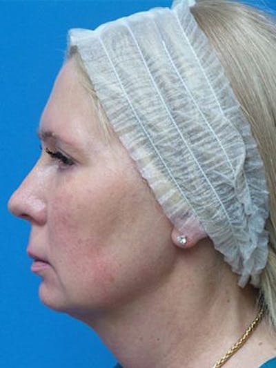 Neck Lift Before & After Gallery - Patient 343803 - Image 1