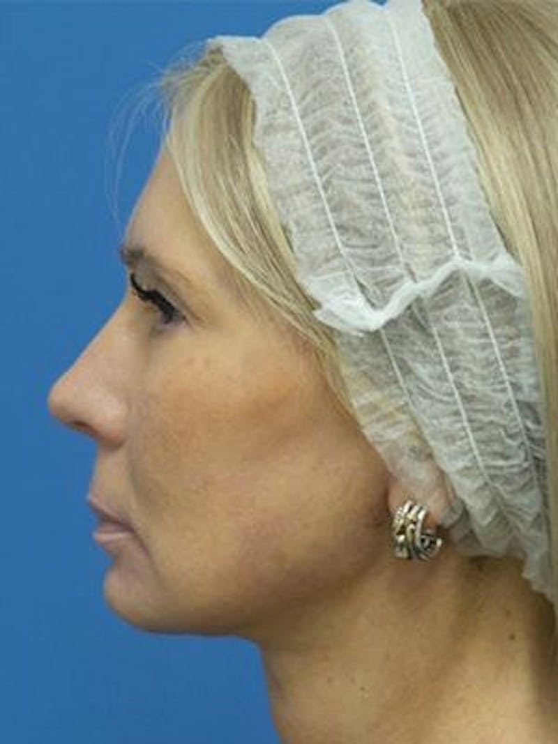 Neck Lift Before & After Gallery - Patient 343803 - Image 2