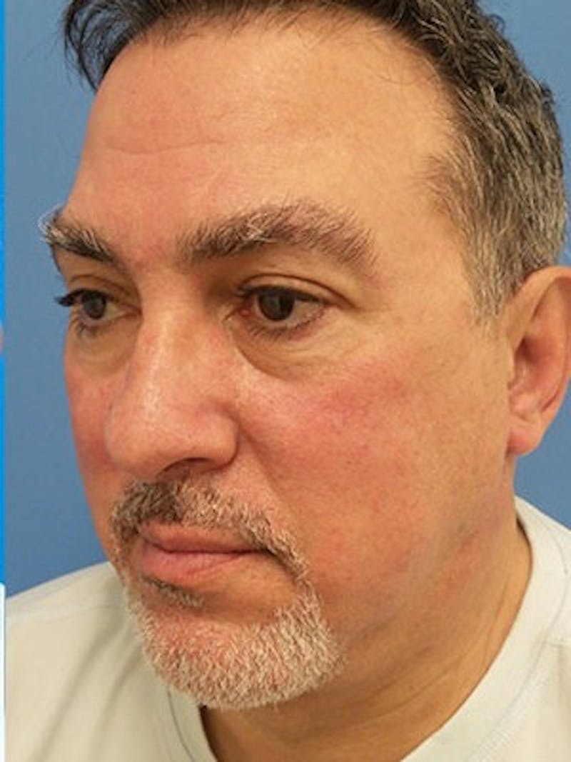 Neck Lift Before & After Gallery - Patient 382473 - Image 2