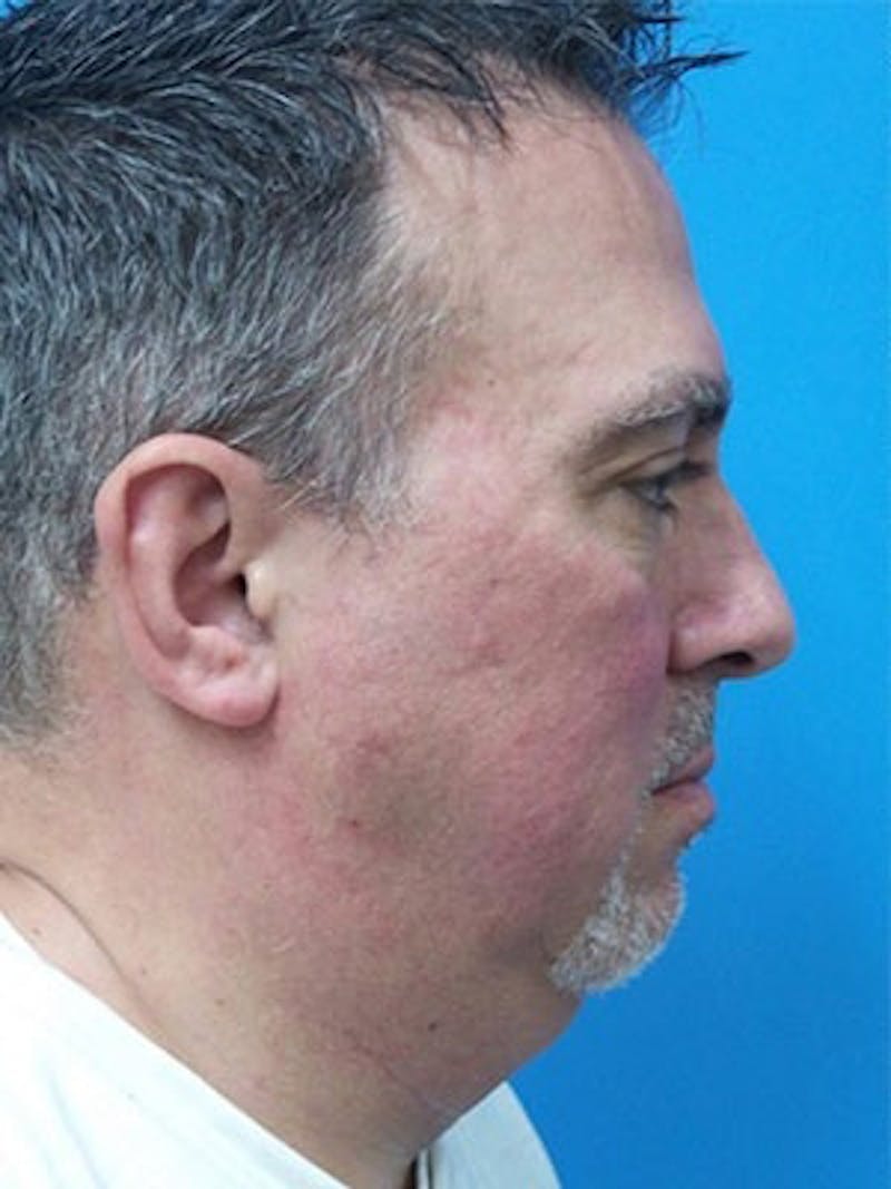 Neck Lift Before & After Gallery - Patient 382473 - Image 5