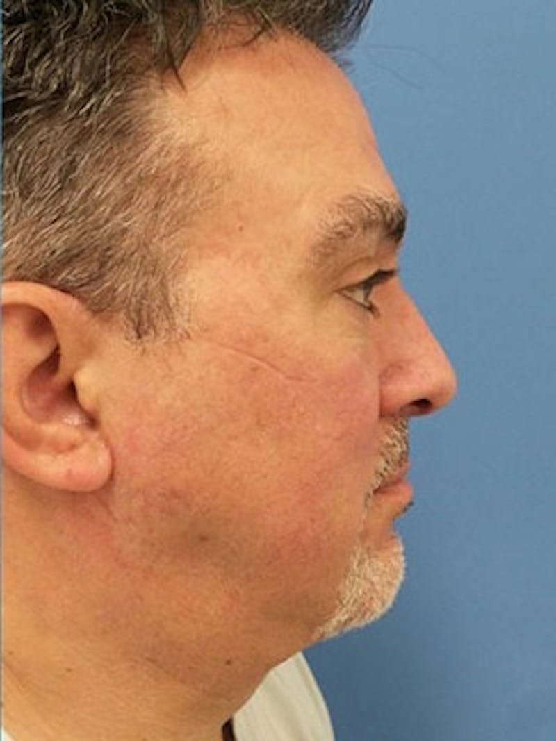Neck Lift Before & After Gallery - Patient 382473 - Image 6