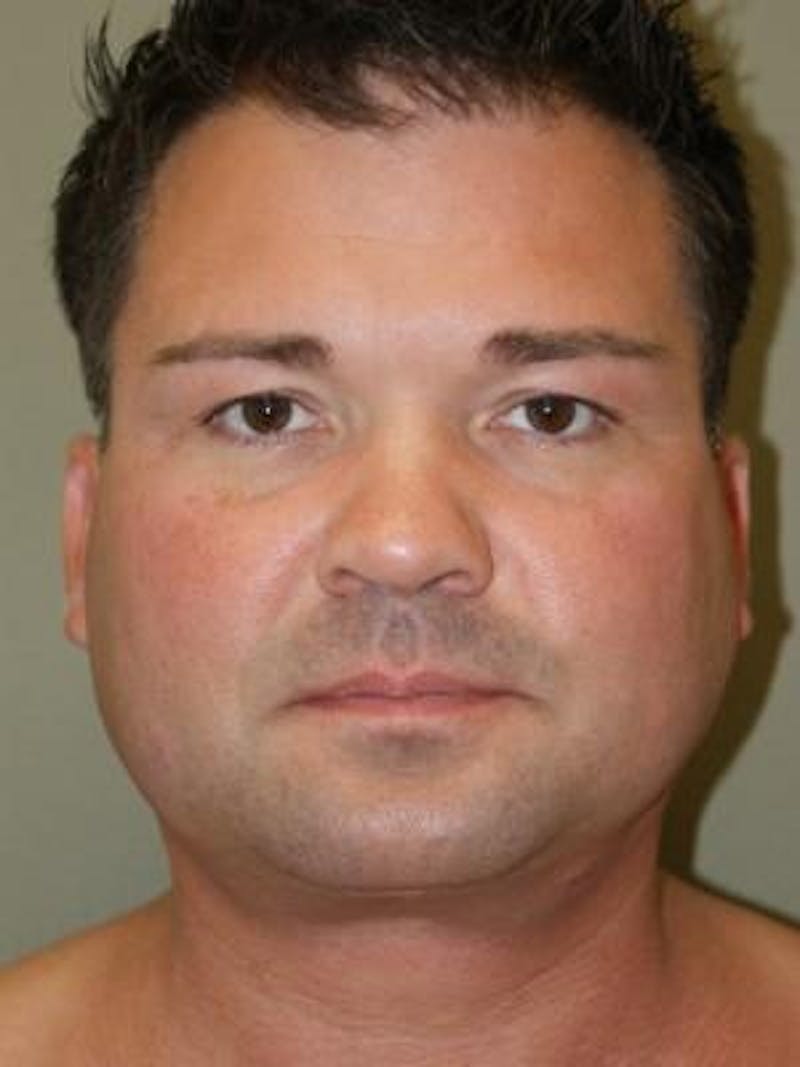 Neck Lift Before & After Gallery - Patient 203898 - Image 4
