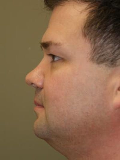 Neck Lift Before & After Gallery - Patient 203898 - Image 1