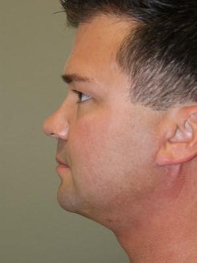 Neck Lift Before & After Gallery - Patient 203898 - Image 2