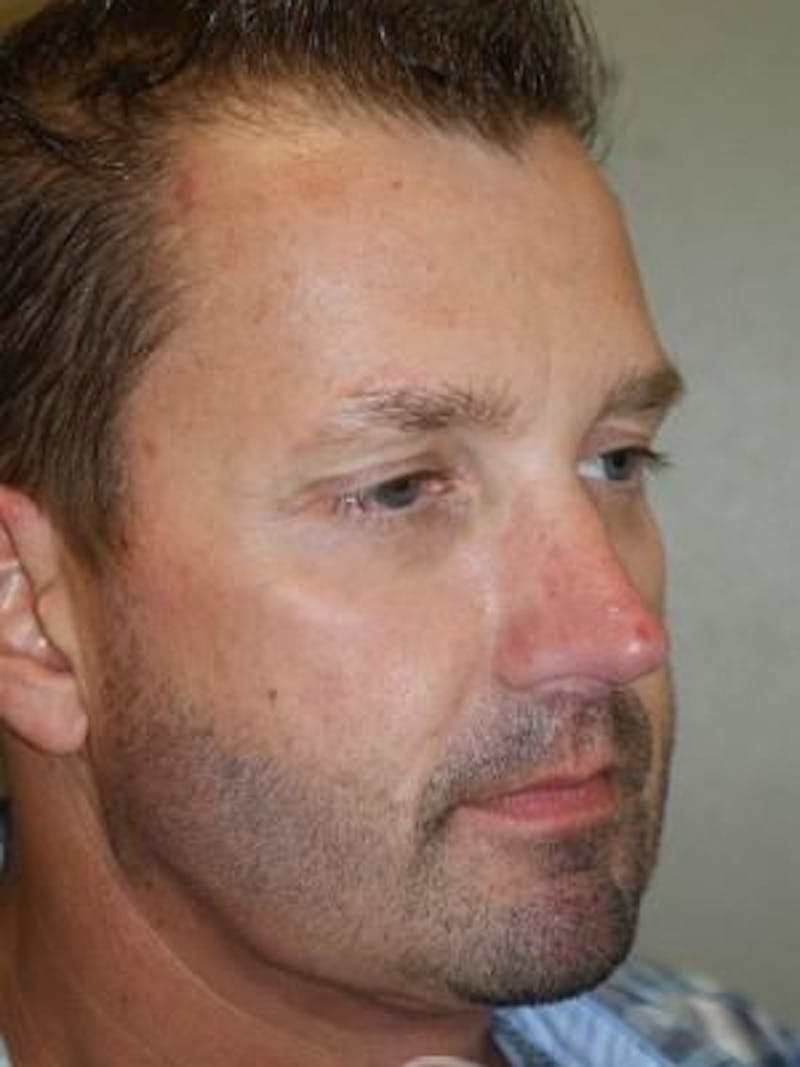 Neck Lift Before & After Gallery - Patient 303461 - Image 4