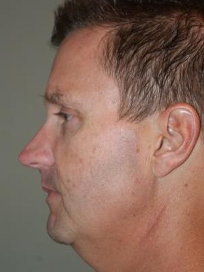 Neck Lift Before & After Gallery - Patient 303461 - Image 1
