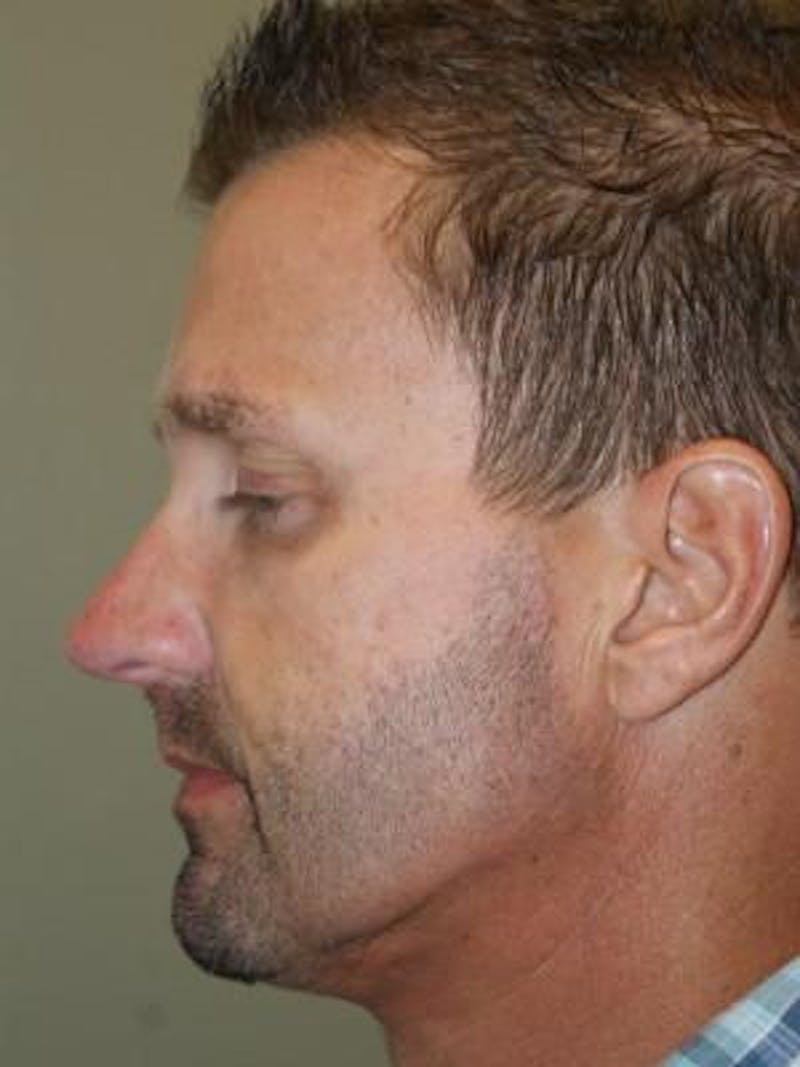 Neck Lift Before & After Gallery - Patient 303461 - Image 2