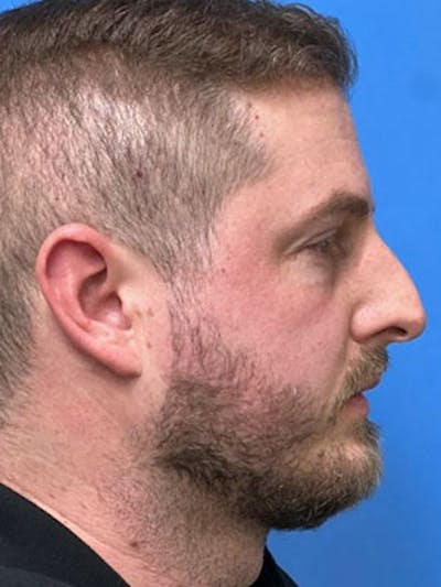 Rhinoplasty Before & After Gallery - Patient 956444 - Image 1