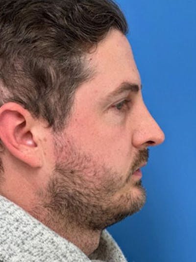 Rhinoplasty Before & After Gallery - Patient 956444 - Image 2