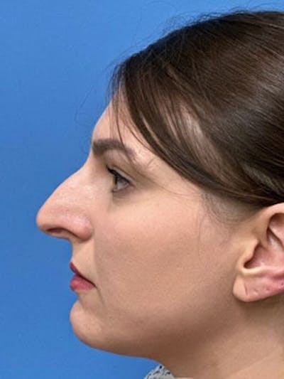 Rhinoplasty Before & After Gallery - Patient 277082 - Image 1