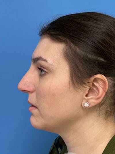 Rhinoplasty Before & After Gallery - Patient 277082 - Image 2