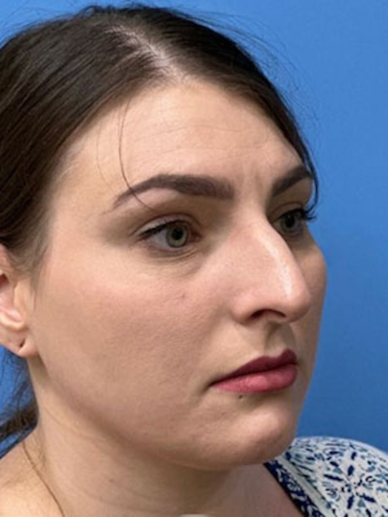 Rhinoplasty Before & After Gallery - Patient 277082 - Image 3
