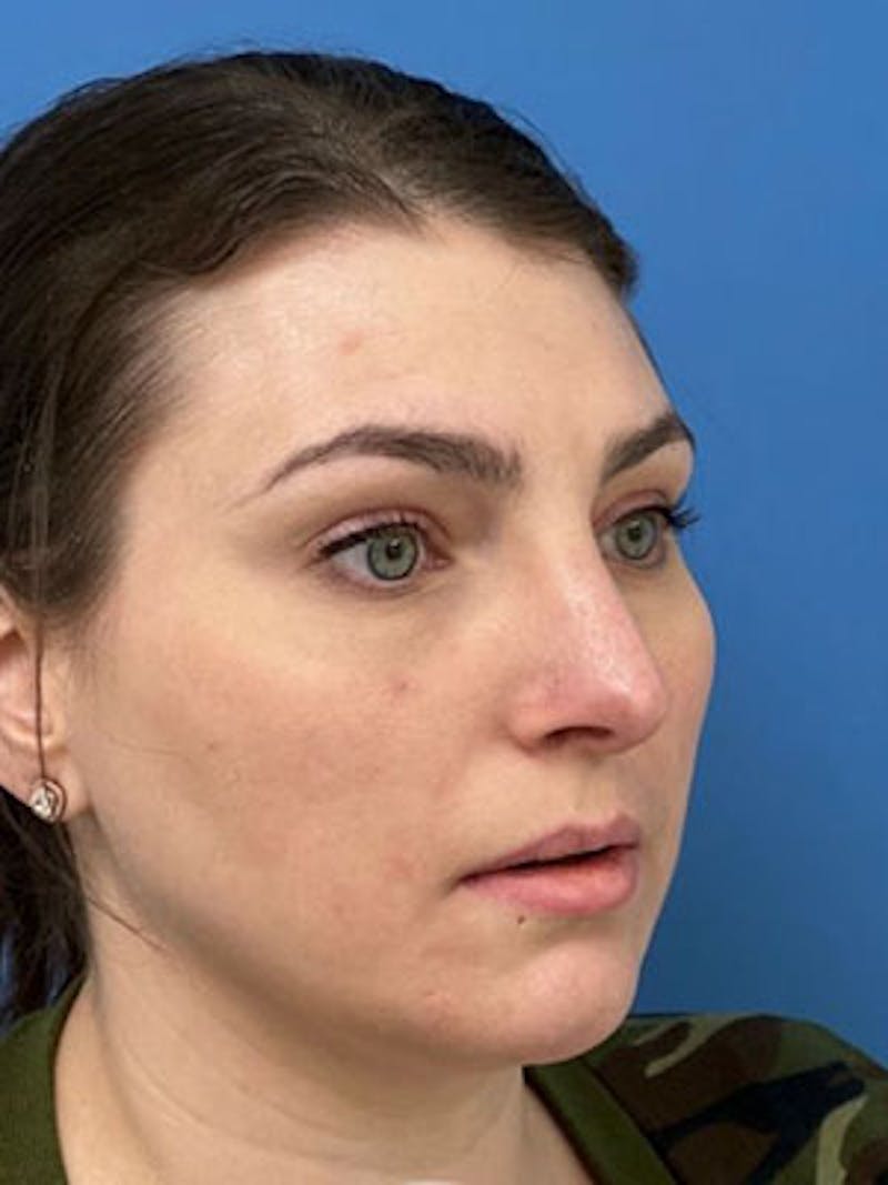 Rhinoplasty Before & After Gallery - Patient 277082 - Image 4