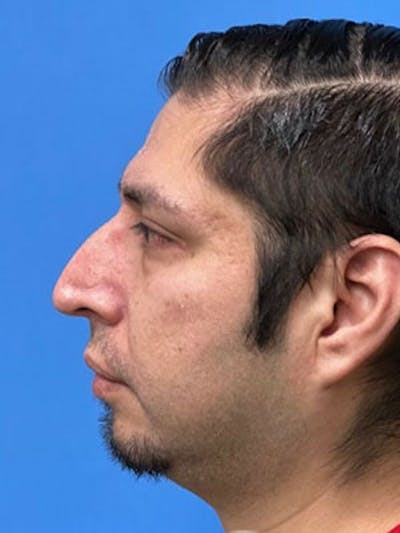 Rhinoplasty Before & After Gallery - Patient 416158 - Image 1