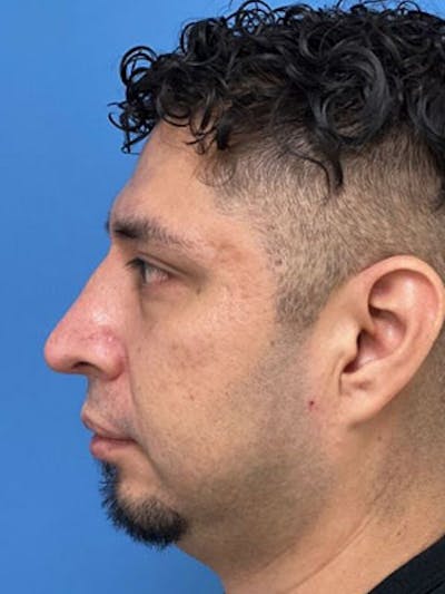 Rhinoplasty Before & After Gallery - Patient 416158 - Image 2