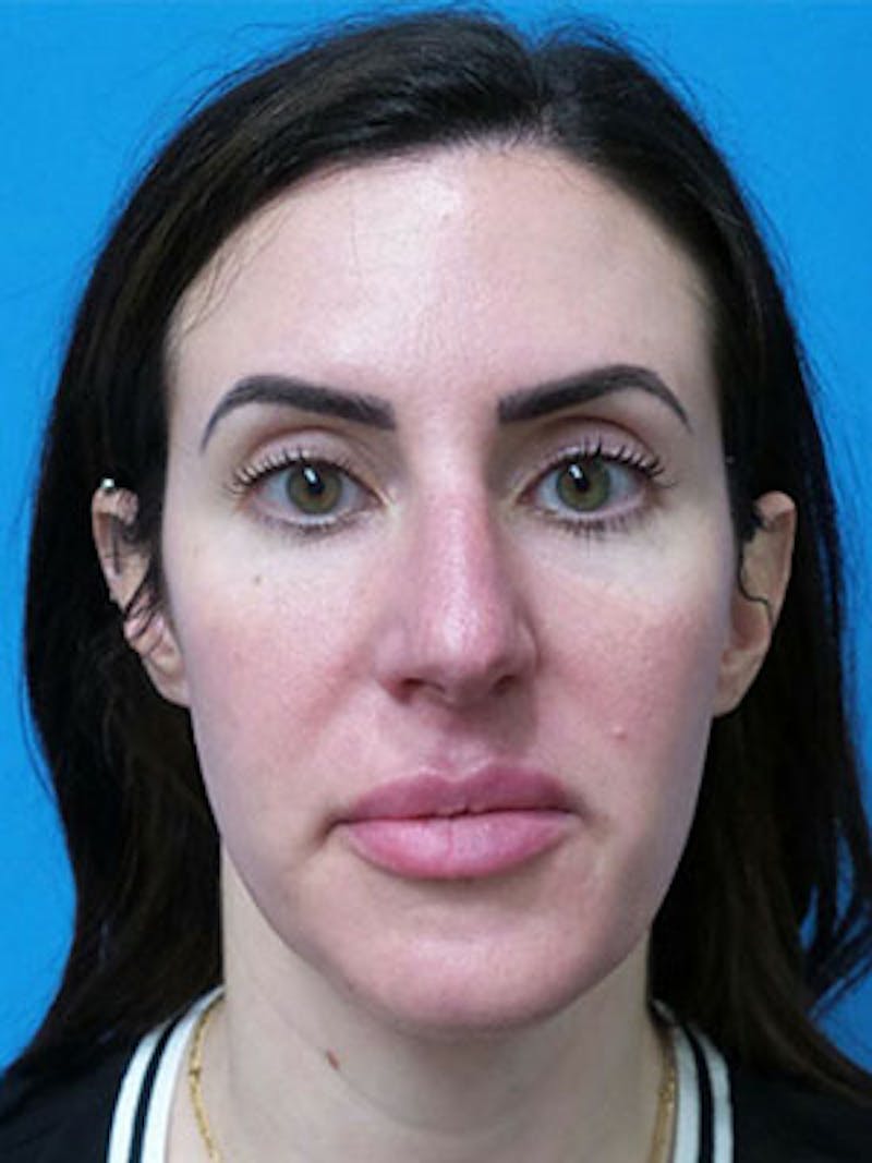 Rhinoplasty Before & After Gallery - Patient 124520 - Image 3